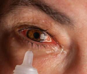 Itchy Eyes: Causes, Symptoms, and Effective Remedies