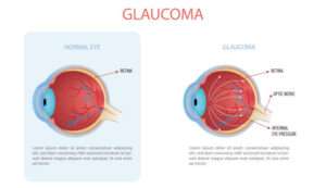 Glaucoma Unveiled: A Comprehensive Guide