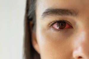 Itchy Eyes: Causes, Symptoms, and Effective Remedies