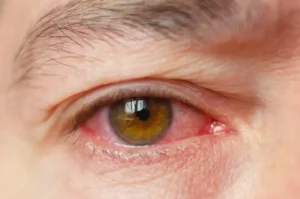 Viral Conjunctivitis