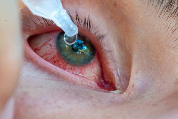 pink eye treatment