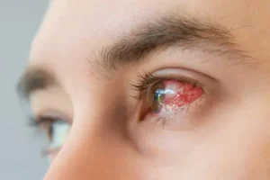 Bacterial Conjunctivitis