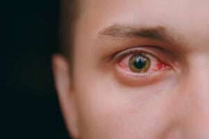 Allergic Conjunctivitis